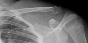 Fracture Clavicle